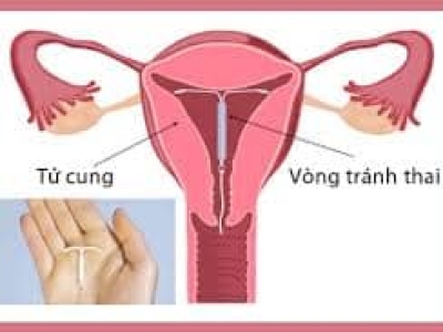 Đặt vòng tránh thai 