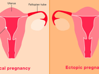 Mang thai ngoài tử cung có kinh nguyệt không? Điều trị thai ngoài tử cung như thế nào?
