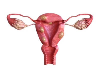 Tìm hiểu về căn bệnh u xơ tử cung ở nữ giới