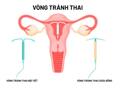 Những điều cần biết về đặt vòng tránh thai 