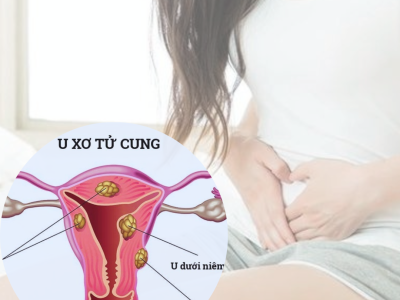 Dấu hiệu nhận biết u xơ tử cung cần đi khám 