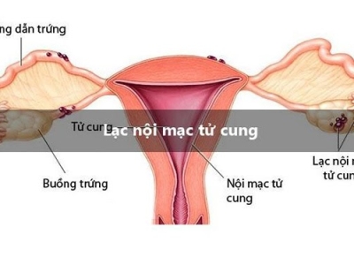 Lạc nội mạc tử cung và những điều cần biết về căn bệnh này 