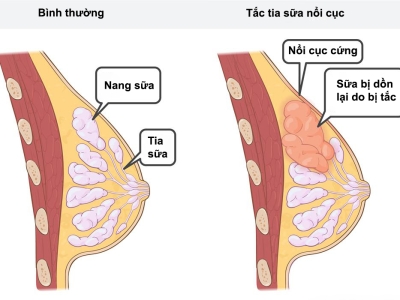 Nguyên nhân gây mất sữa ở mẹ bỉm sữa - Sản phụ khoa Anna 